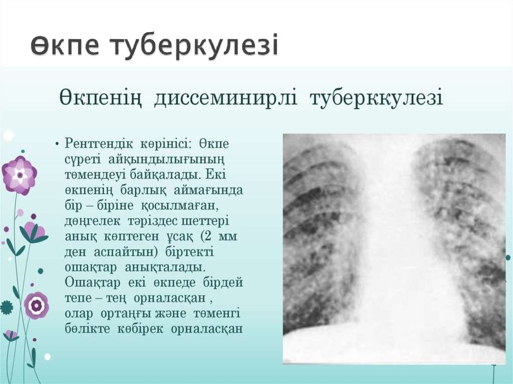 Өкпе туберкулезі презентация