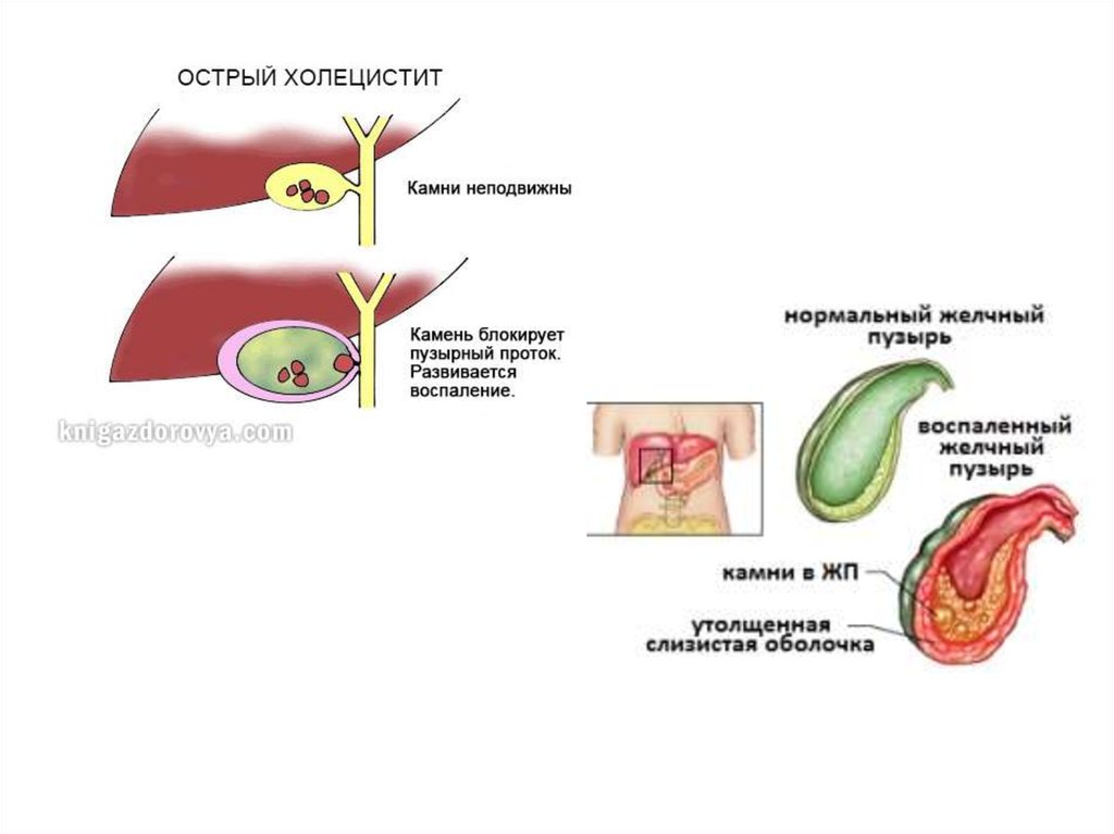 Холецистит книги. Памятка по холециститу.