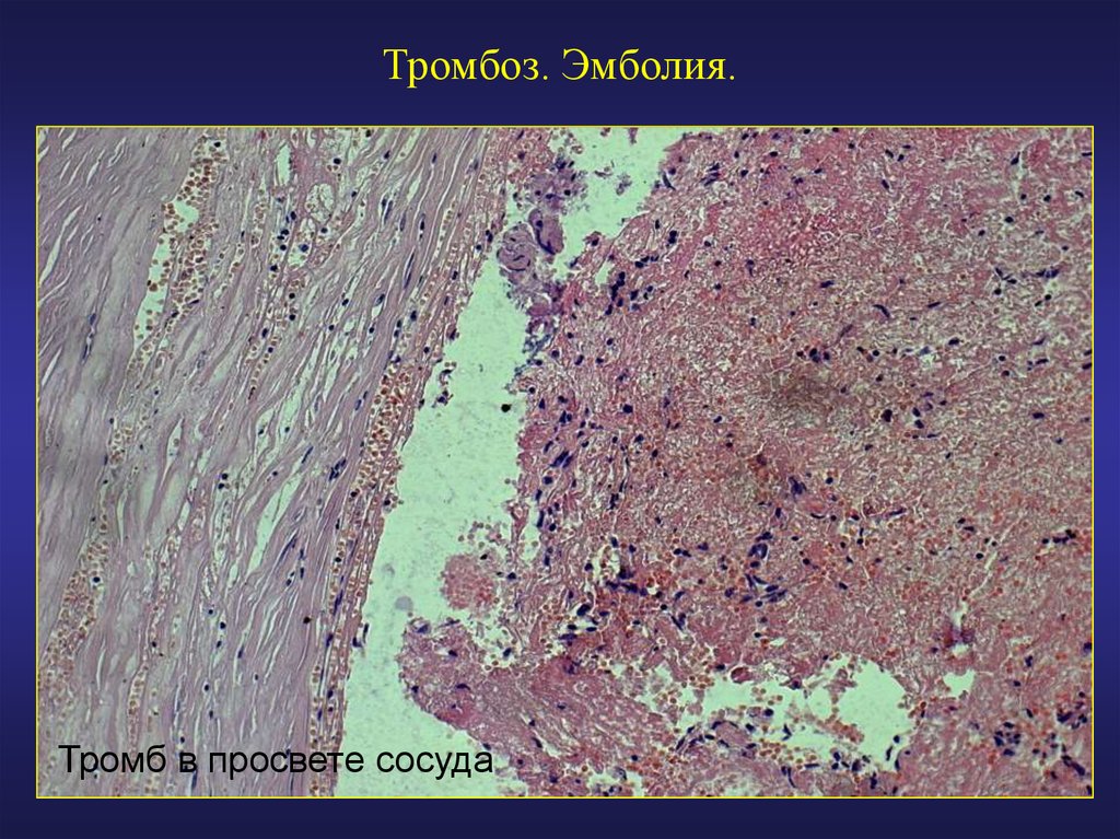 Тромбозы и эмболии артерий. Тромб артерии микропрепарат. Жировая эмболия гистология.