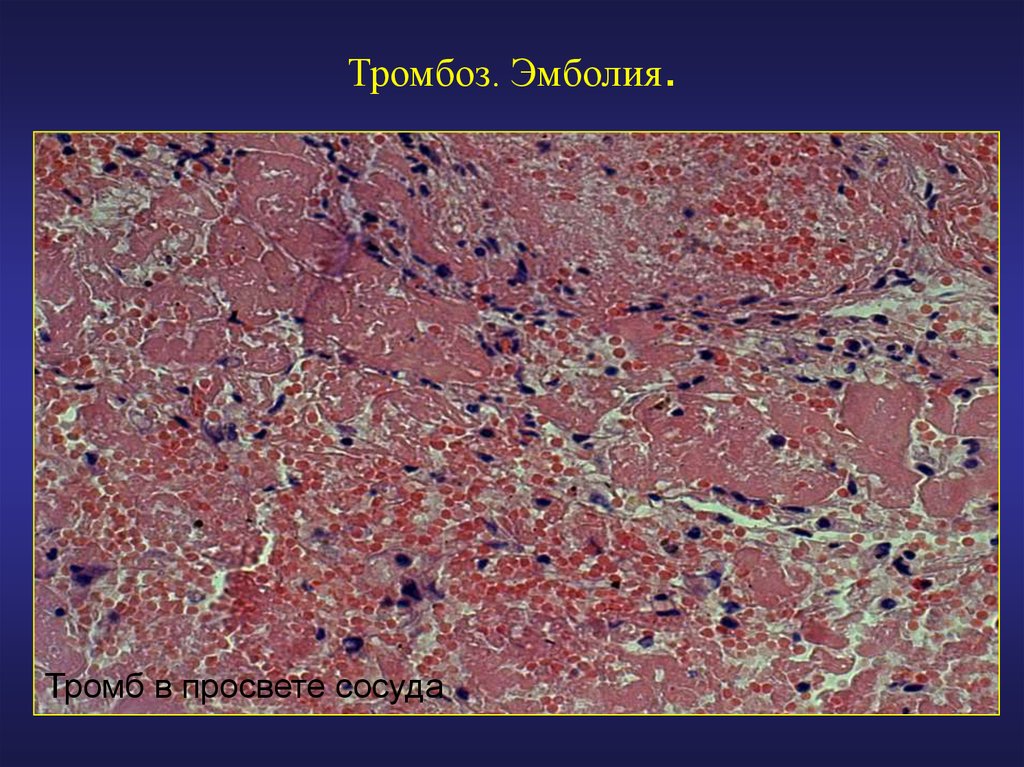 Тромб микропрепарат. Тромбо легочная эмболия. Тромбоэмболия легочной артерии макропрепарат. Тромб артерии микропрепарат.