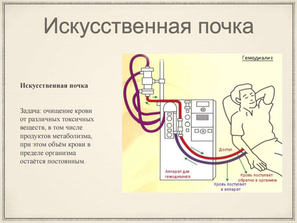 Схема искусственной почки