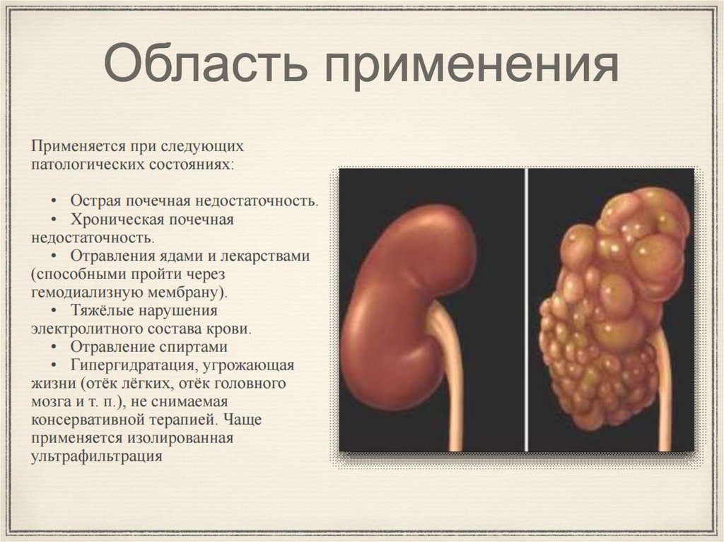 Искусственная почка - презентация онлайн