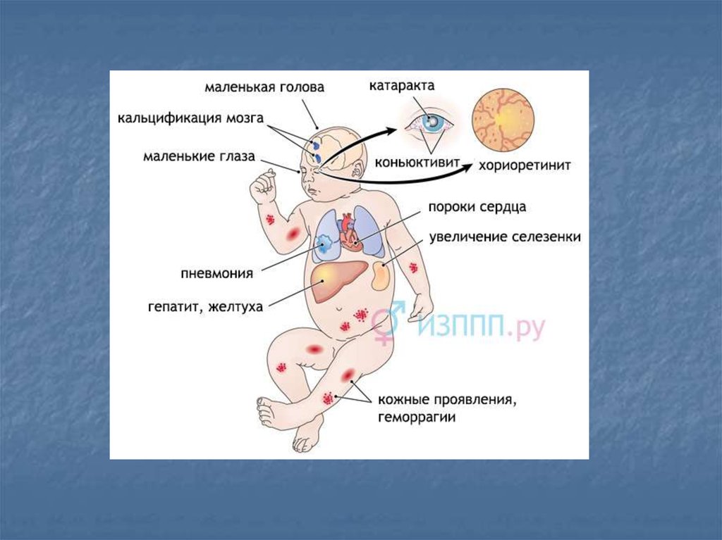 Внутриутробные инфекции плода презентация