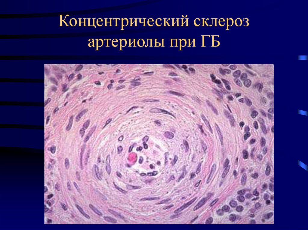 Концентрический склероз артериолы при ГБ