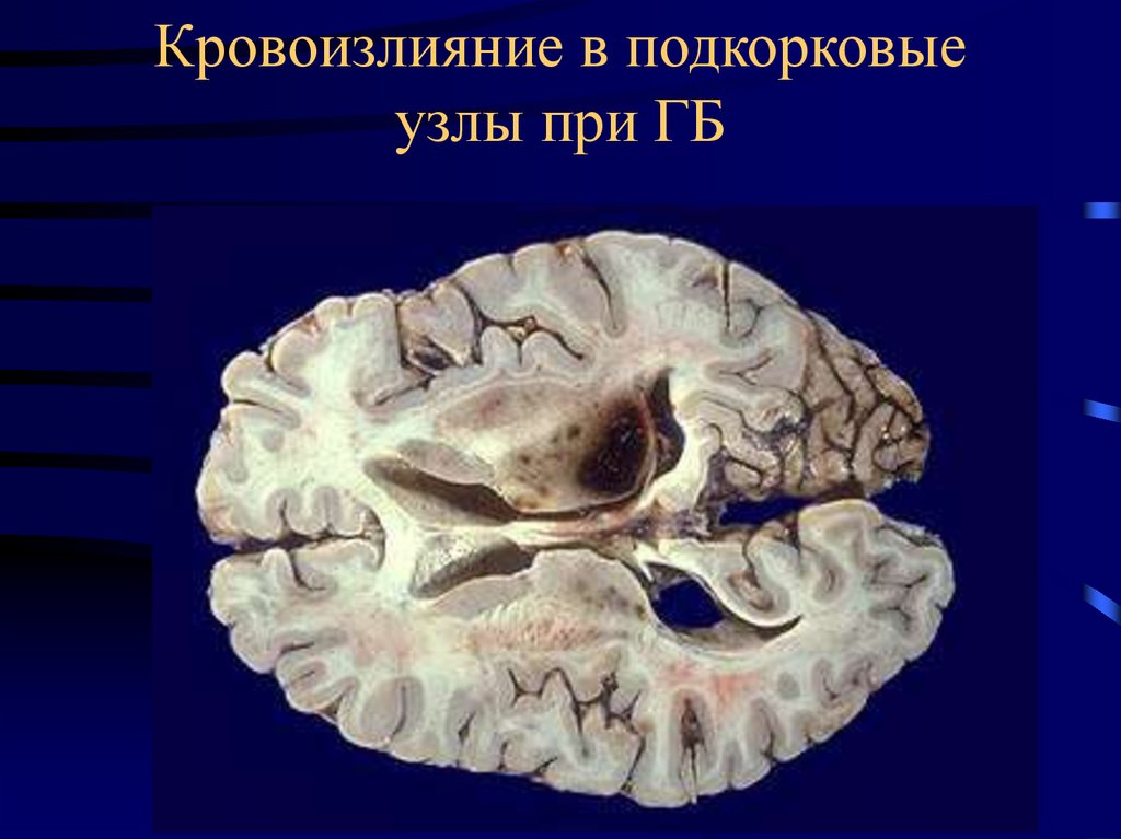 Мозге форум. Кровоизлияние в мозг макропрепарат. Кровоизлияние в головной мозг макропрепарат. Внутриопухолевое кровоизлияние.