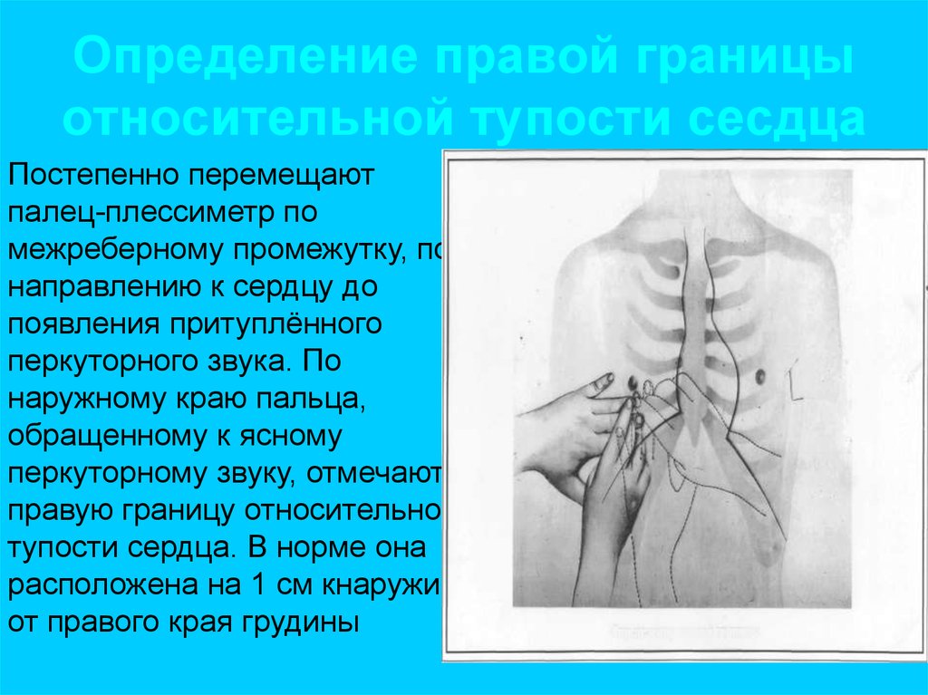 Правая граница. Пальпация прекардиальной области. Методика пальпации прекардиальной области. Пальпация прекардиальной области схема. Кнаружи от правого края грудины.