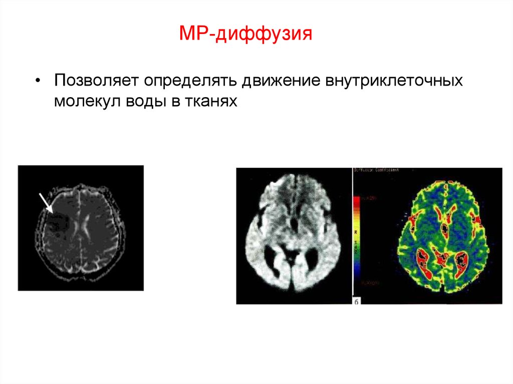 Диффузия и перфузия. МР диффузия. МР перфузия и МР диффузия. Отличия МР диффузии и МР перфузии. МР диффузия всего тела.