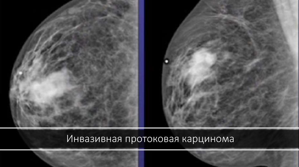 Инфильтративный рак молочной железы фото