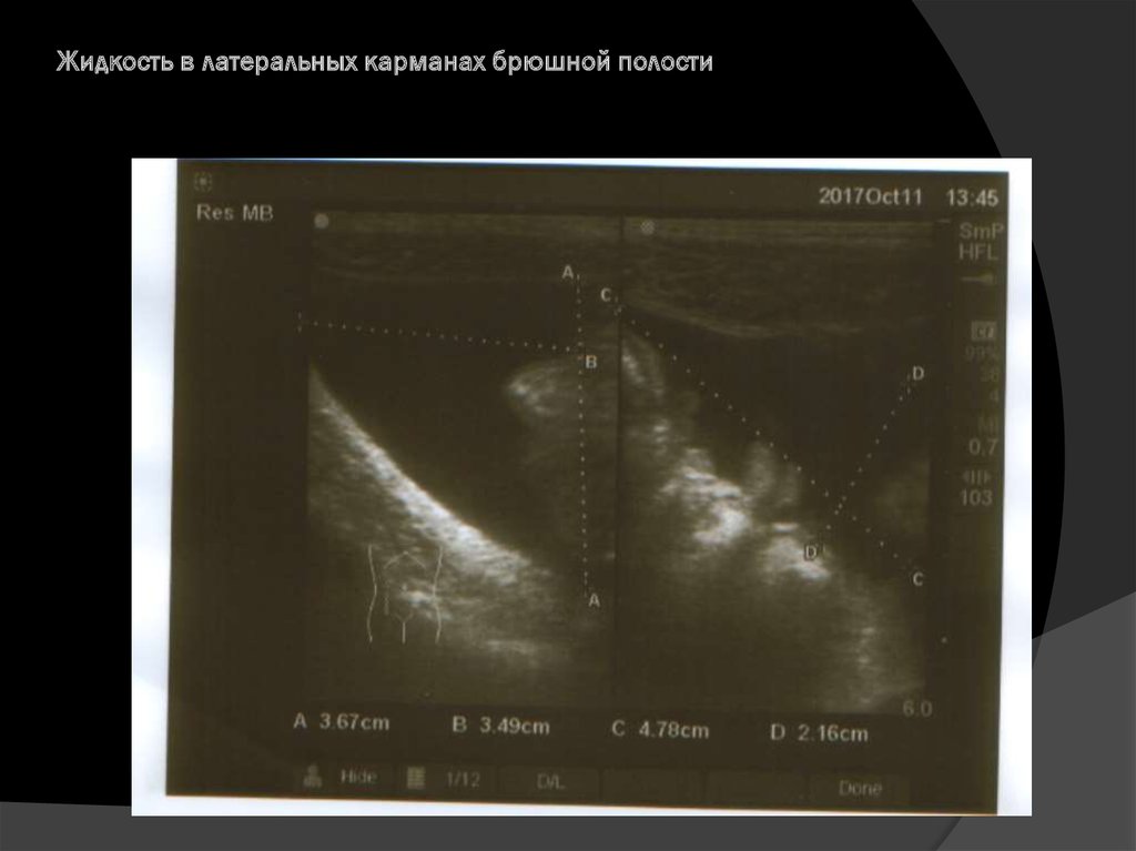 Жидкость в брюшной полости. Осумкованная жидкость в брюшной полости. Карманы брюшной полости по УЗИ. Жидкость в латеральных карманах брюшной полости. Карманы жидкости на УЗИ.