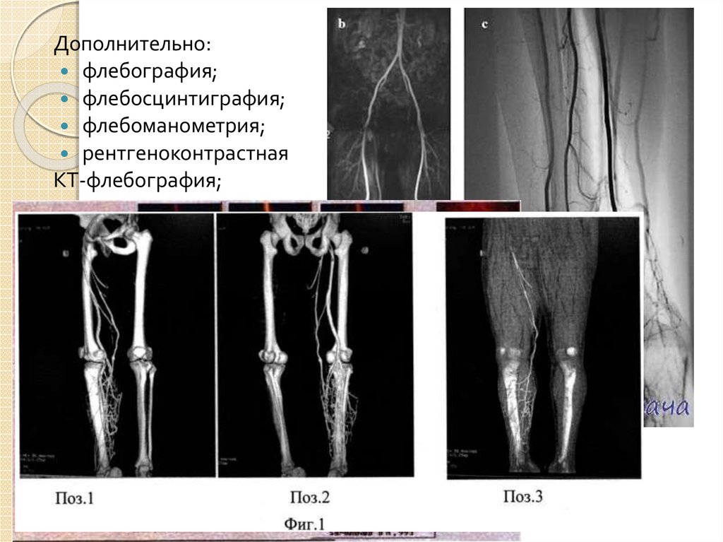 Флебография вен нижних. Ретроградная флебография. Кт флебография верхних конечностей. Абдоминальная флебография. Флебография нижних конечностей.