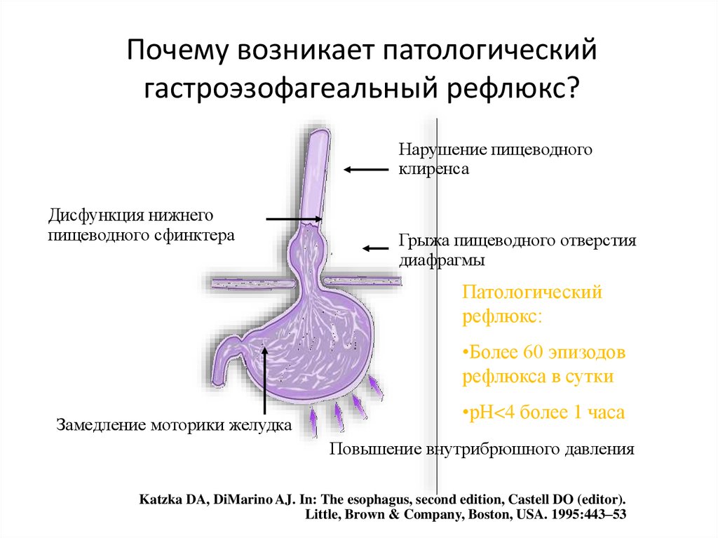 Эзофагальный рефлюкс