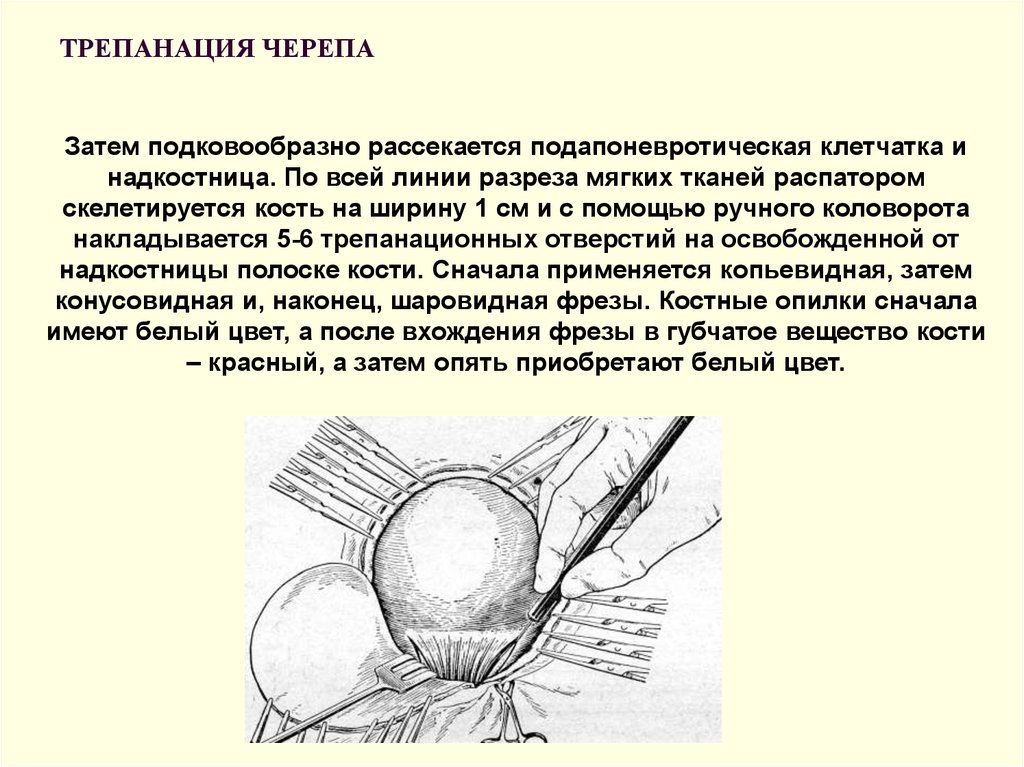 Трепанация. Костно-пластическая Трепанация черепа техника. КПТЧ Трепанация черепа. Костнопластическая Трепанация техника. Костно-пластическая Трепанация черепа показания.