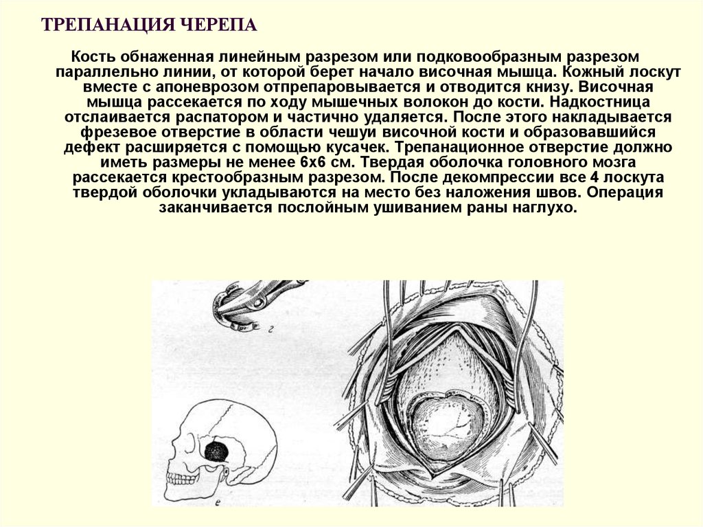 Костно пластическая трепанация черепа презентация