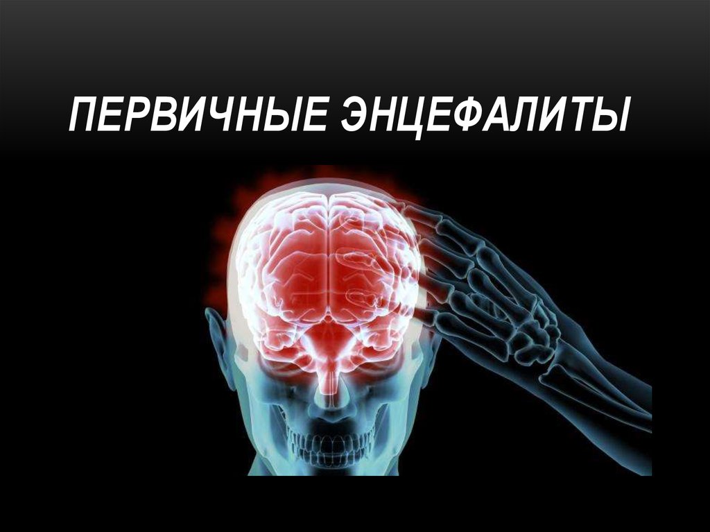 Энцефалит головного мозга у взрослых. Первичные энцефалиты. Энцефалиты неврология. Энцефалит головного мозга. Вирусный энцефалит головного мозга.