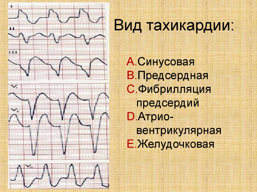 Экг картина при пароксизме суправентрикулярной тахикардии имеет вид