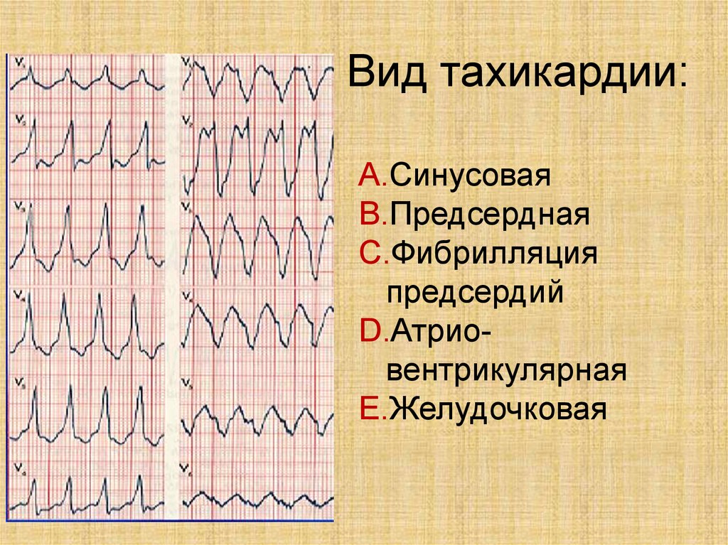 Синусовая тахикардия что. Тахикардия. Синусовая тахикардия виды. Симптомы при тахикардии. Синусовая и предсердная тахикардия.