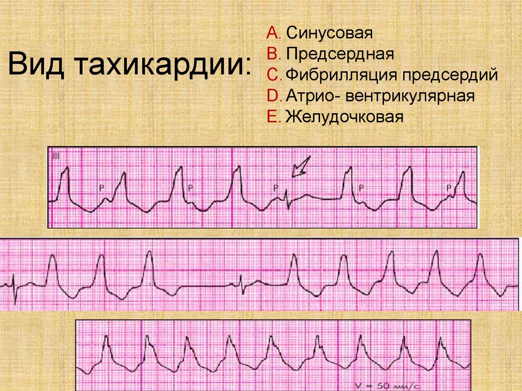 Тахикардия на экг