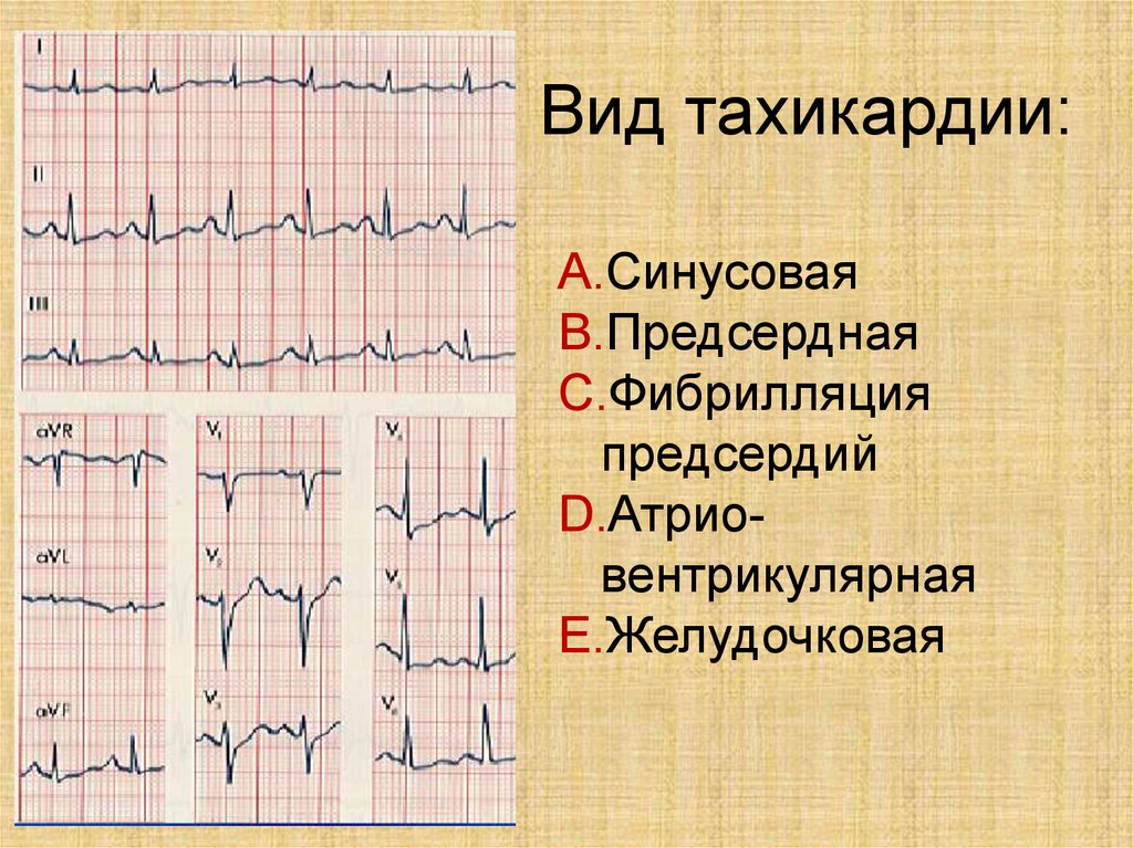 Тахикардия осложнения. Синусовый ритм на ЭКГ. Синусовая тахикардия сердца ЭКГ. Тахикардия на ЭКГ. Тахикардия сердца на ЭКГ.