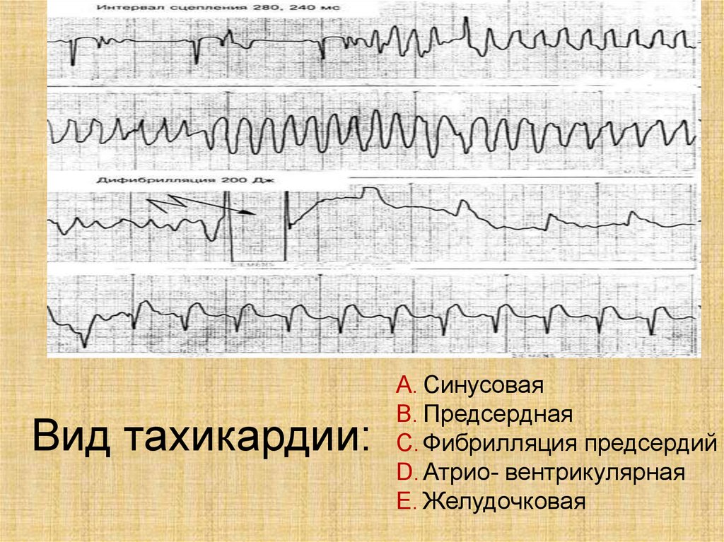 Карта смп фибрилляция предсердий