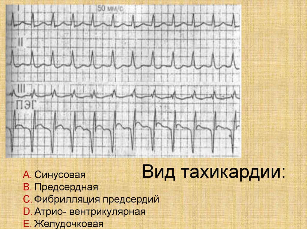 Пароксизмальная тахикардия карта смп