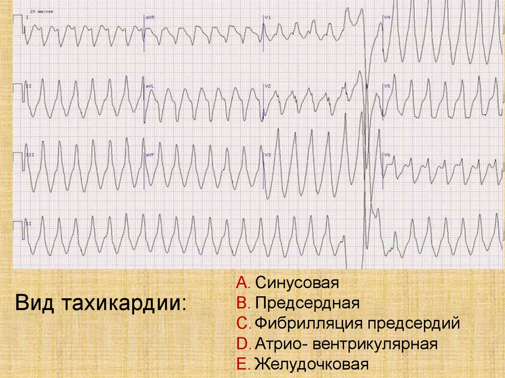 Синусовая тахикардия что. Фибрилляция предсердий и тахикардия. Желудочковая тахикардия на фоне фибрилляции предсердий. Синусовая тахикардия и фибрилляция предсердий. Фибрилляция предсердий и синусовая тахикардия ЭКГ.