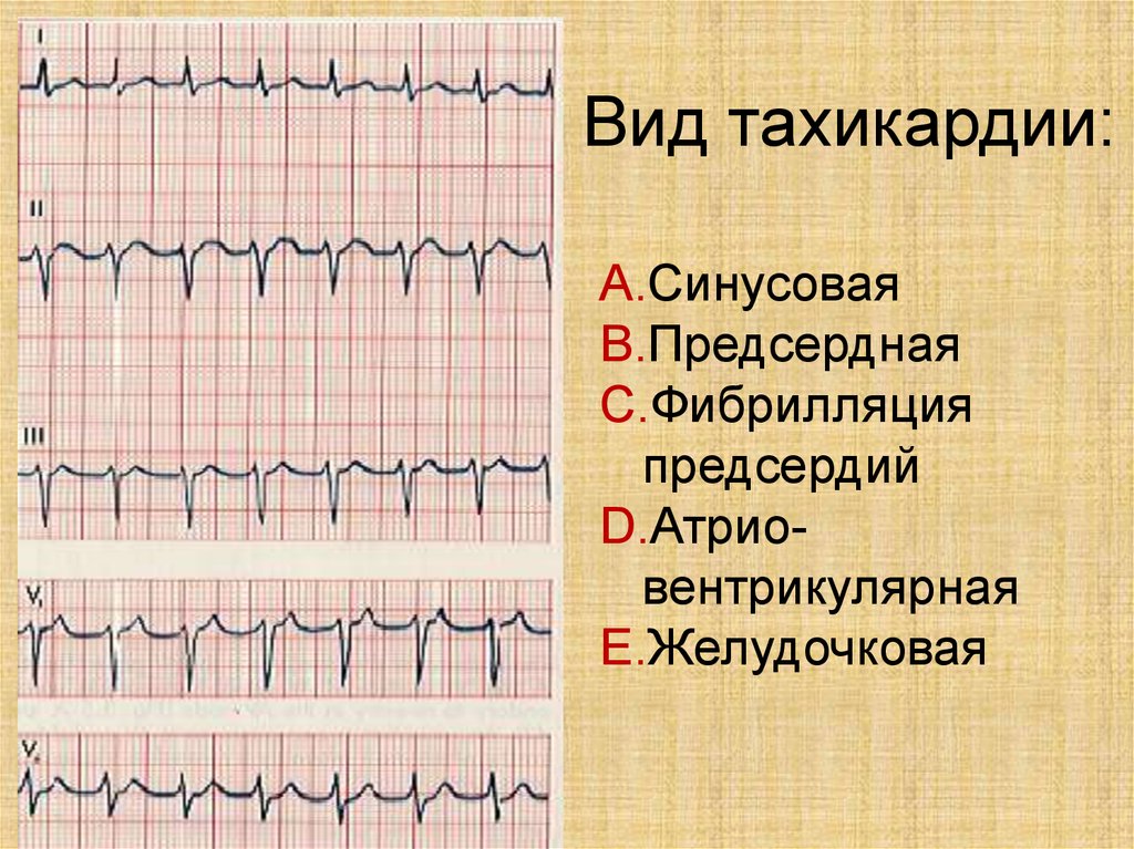 Что такое тахикардия сердца. Виды тахикардии. Синусовая тахикардия виды. Синдром синусовой тахикардии. Синусовая тахикардия и фибрилляция предсердий.