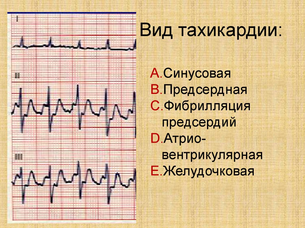 Тахикардия на экг