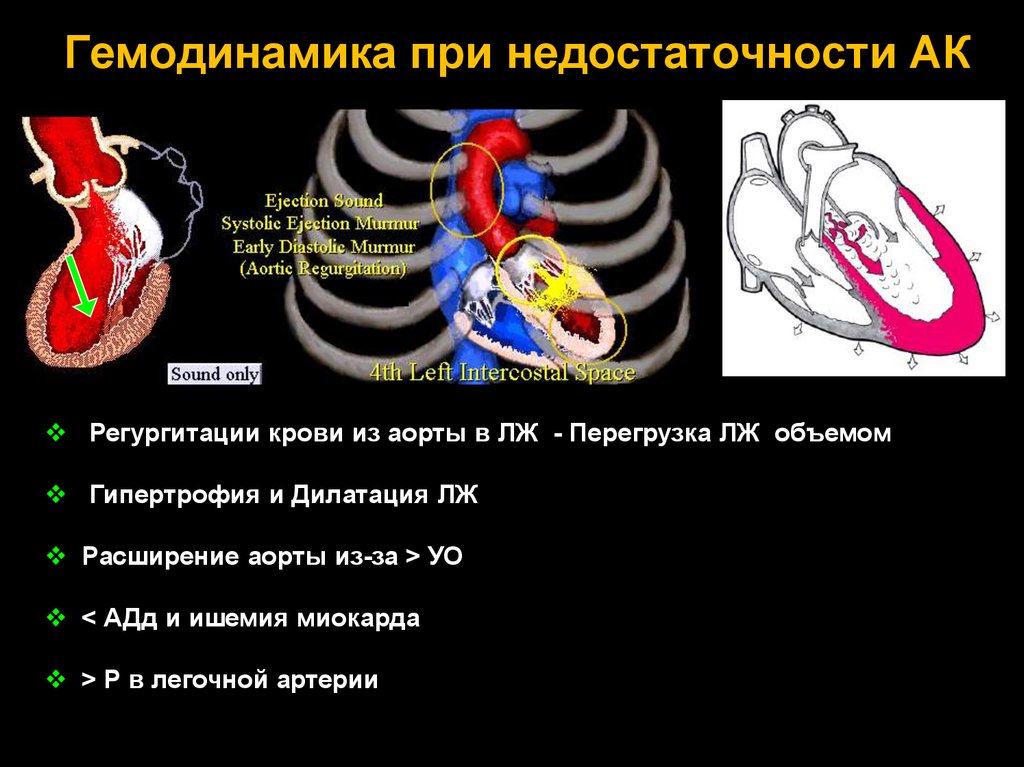 Аортальная регургитация. Аортальная недостаточность гемодинамика. Гемодинамика при аортальной недостаточности. Недостаточность аортального клапана гемодинамика. Гемодинамика митральной регургитации.