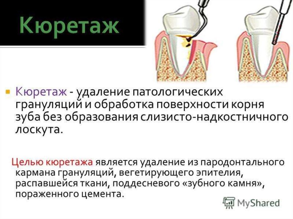 Методы лечения пародонта. Открытый и закрытый кюретаж. Кюретаж открытый кюретаж. Глубокий кюретаж зубодесневого кармана.