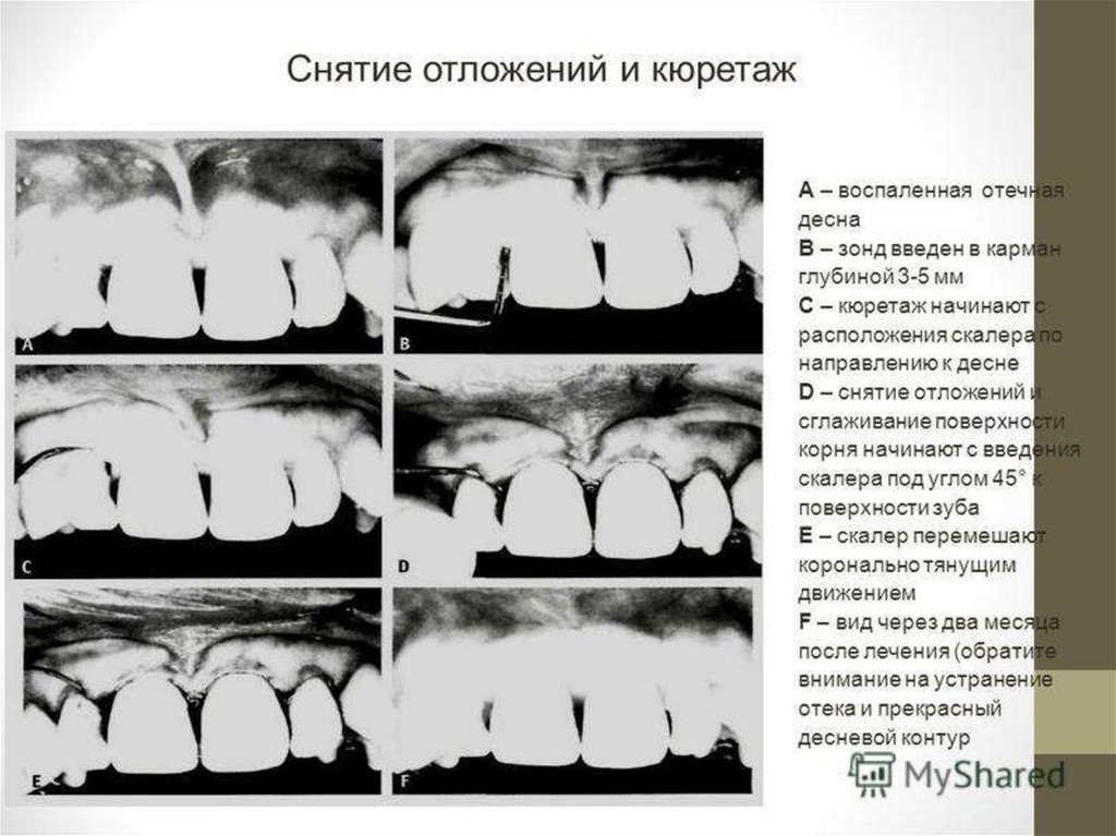 Хирургические методы лечения заболеваний пародонта презентация