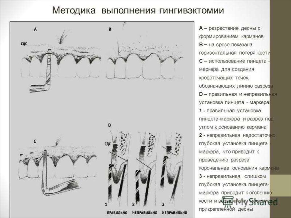 Хирургические методы лечения заболеваний пародонта презентация