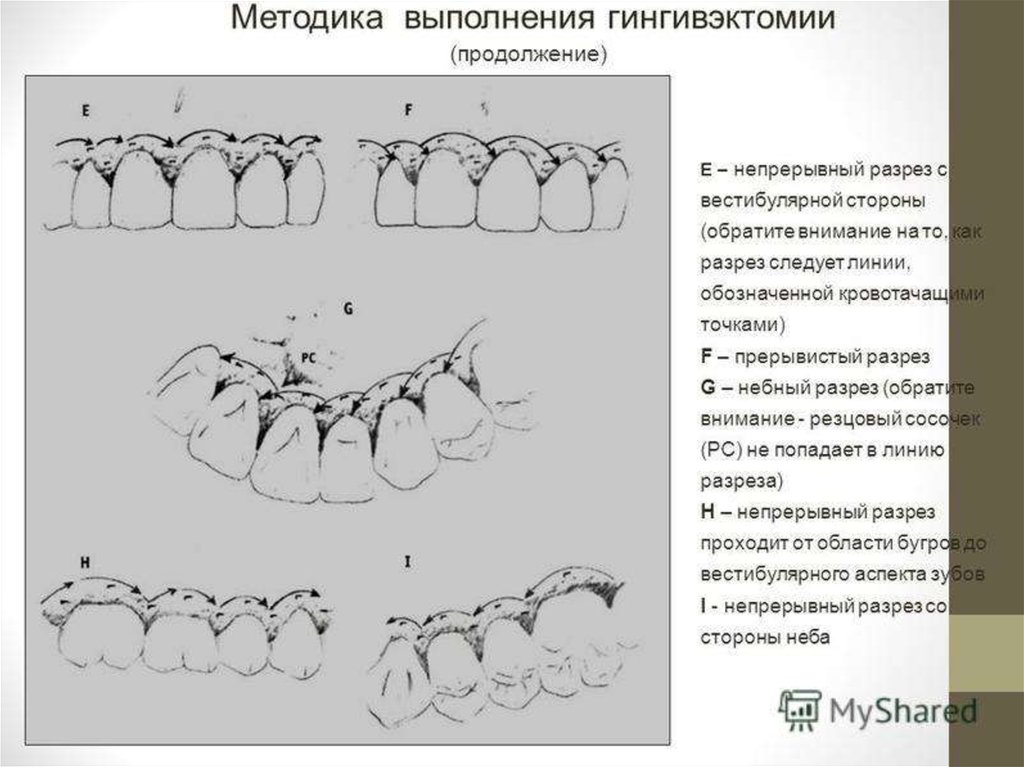 Гингивэктомия это. Гингивотомия и гингивоэктомия. Гингивотомия методика. Лоскутная операция методика.