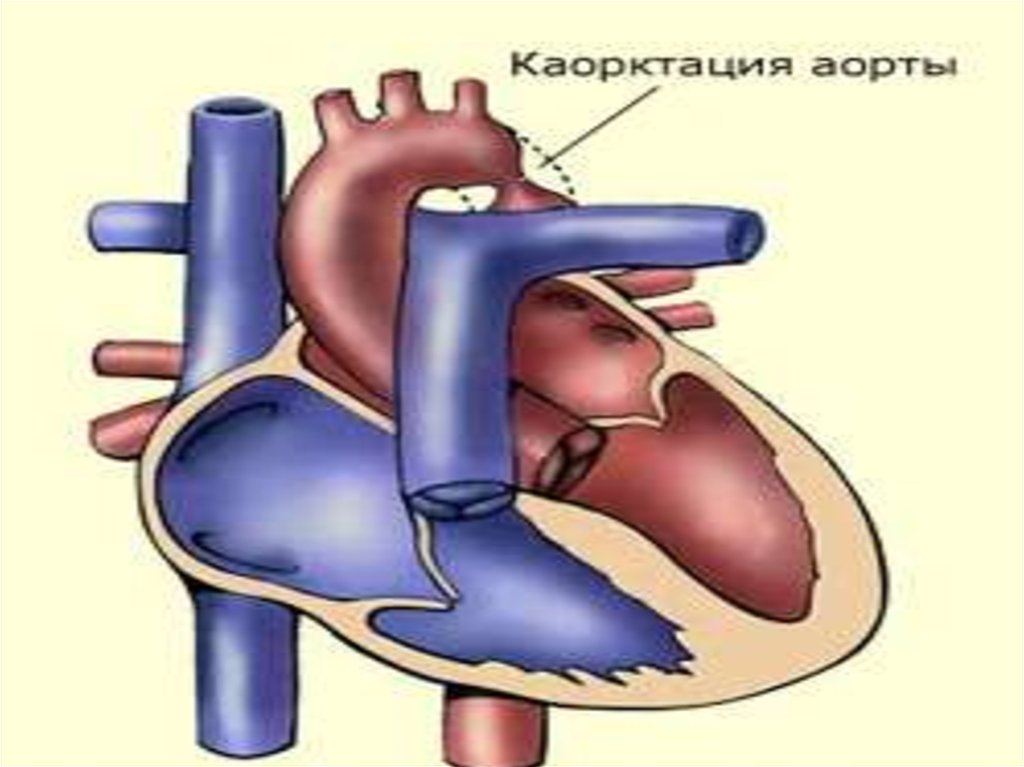 Аорта коартациясы - online presentation