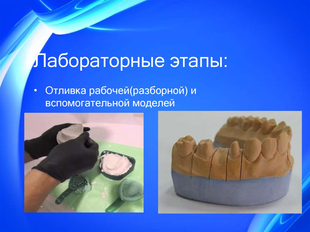 Клинико лабораторные этапы бюгельного