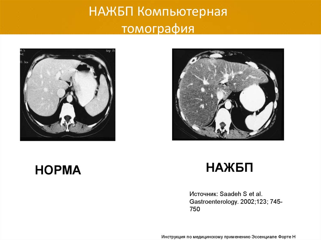 Неалкогольная болезнь. Компьютерная томография НАЖБП. Компьютерная томография пациента с НАЖБП.