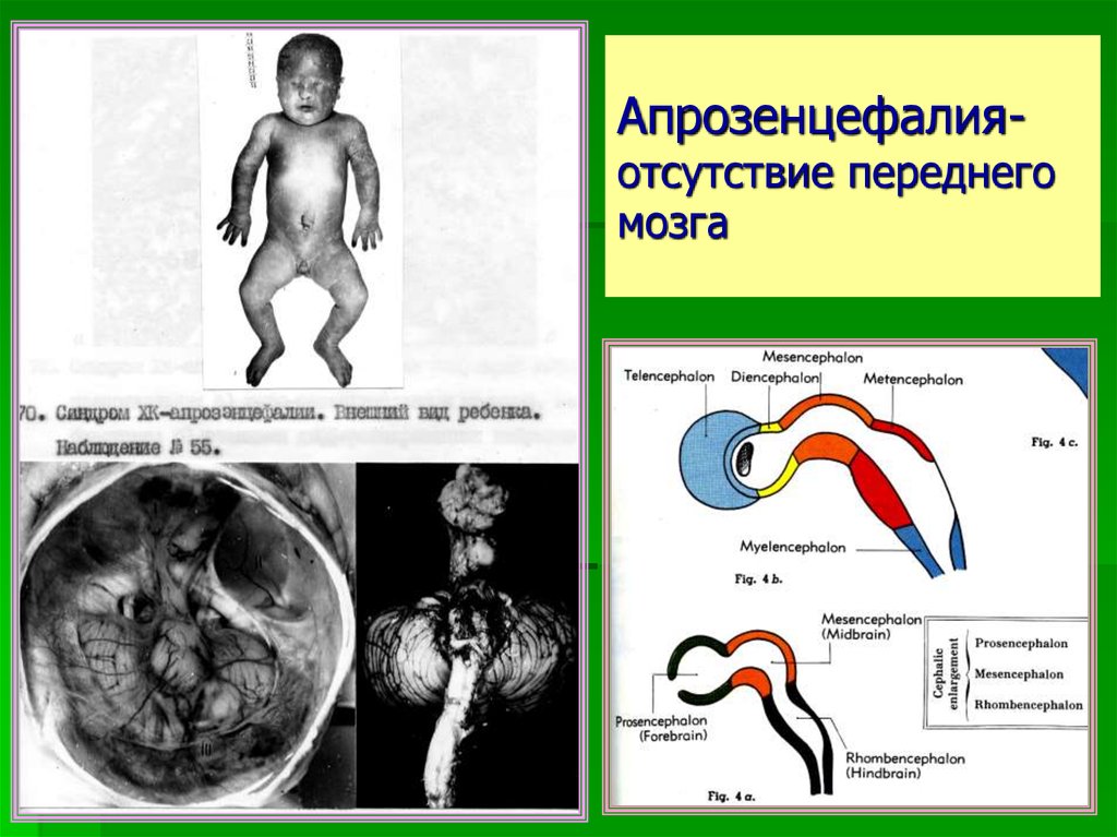 Отсутствие мозга. Аномалия переднего мозга. Болезнь отсутствие мозга. У ребенка отсутствует мозг.