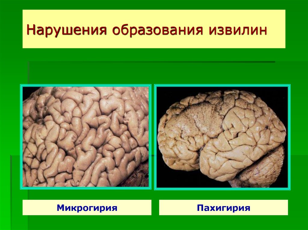 Пахигирия. Лиссэнцефалия-пахигирия. Агирия головного мозга.