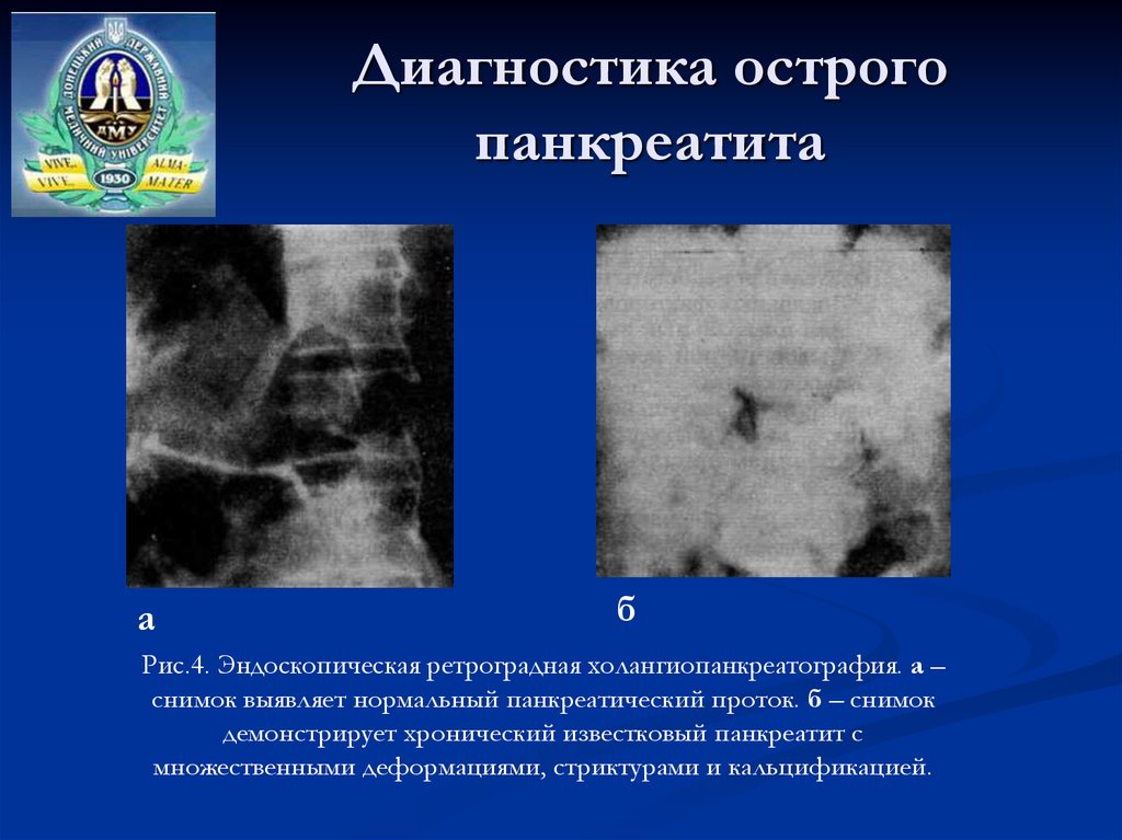 Инструментальные исследования острого панкреатита. Инструментальные исследования при остром панкреатите. Инструментальные методы исследования острого панкреатита. Диагностические признаки острого панкреатита.