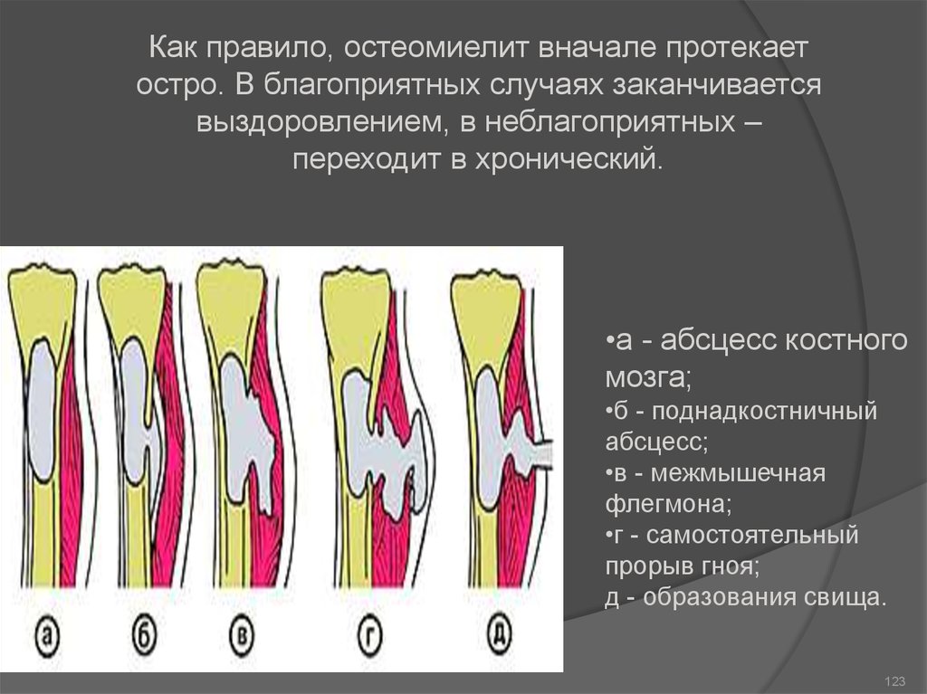 Протекает остро. Поднадкостничного абсцесса. Поднадкостничный гнойник.