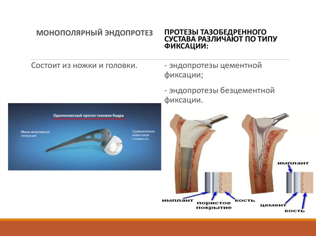 Схема реабилитации после эндопротезирования тазобедренного сустава