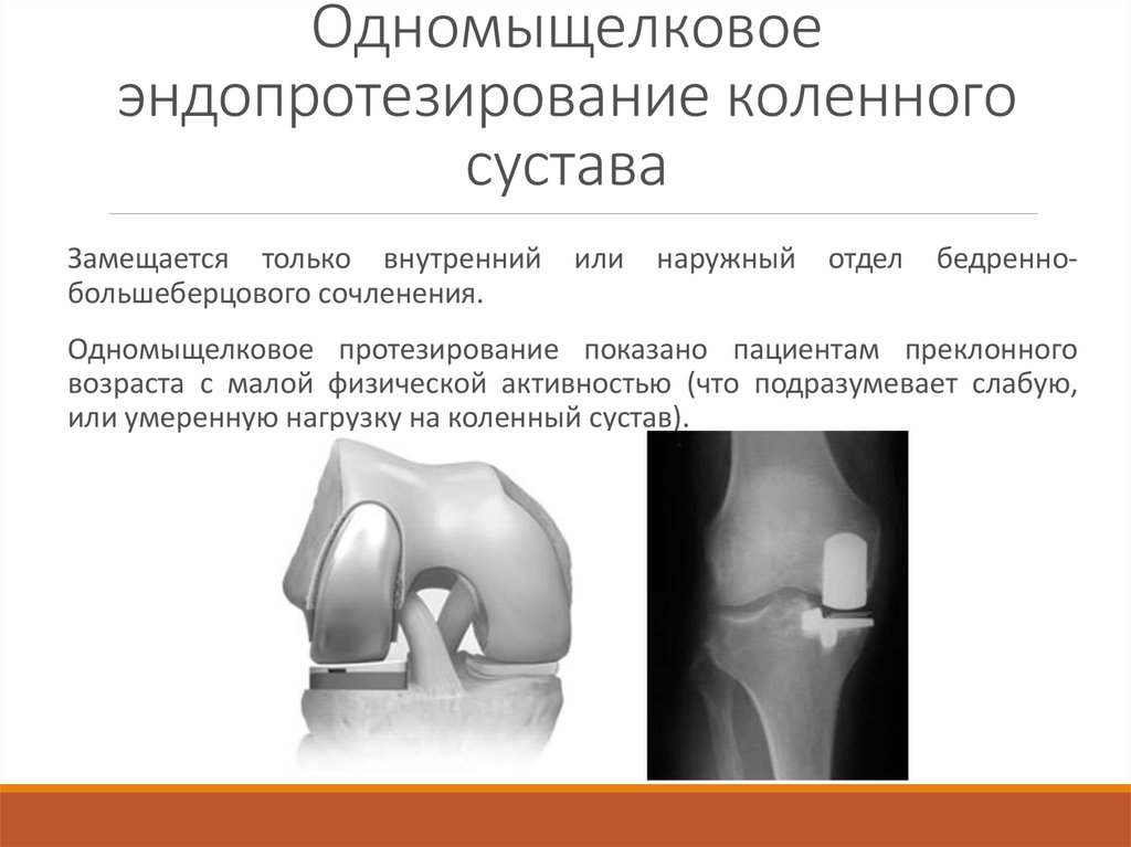 Эндопротезирование коленного сустава клиника. Одномыщелковое эндопротезирование коленного рентген. Эндопротез мыщелка коленного сустава. Тотальное эндопротезирование коленного сустава DEPUY. Одномыщелковое эндопротезирование тазобедренного сустава.