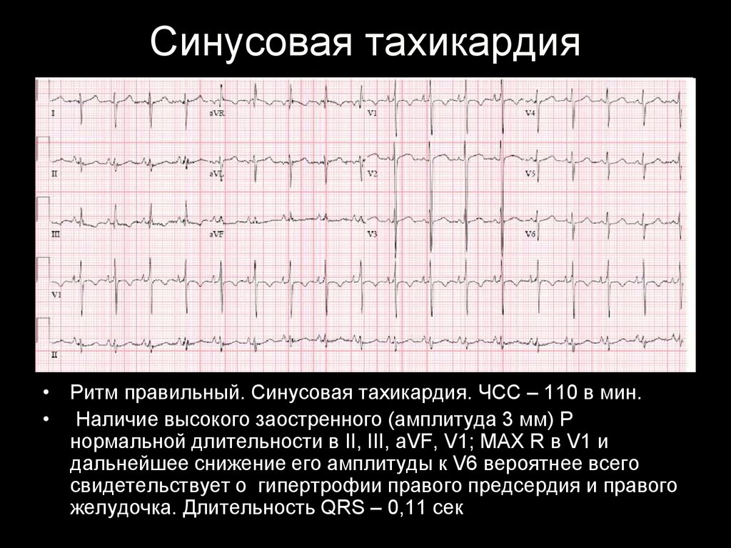 Что значит синусовый ритм сердца на экг. ЭКГ тахикардия синусовый ритм. ЭКГ синусовая тахикардия пленка. ЭКГ при синусовой тахикардии сердца. Заключение ЭКГ ритм синусовая тахикардия.