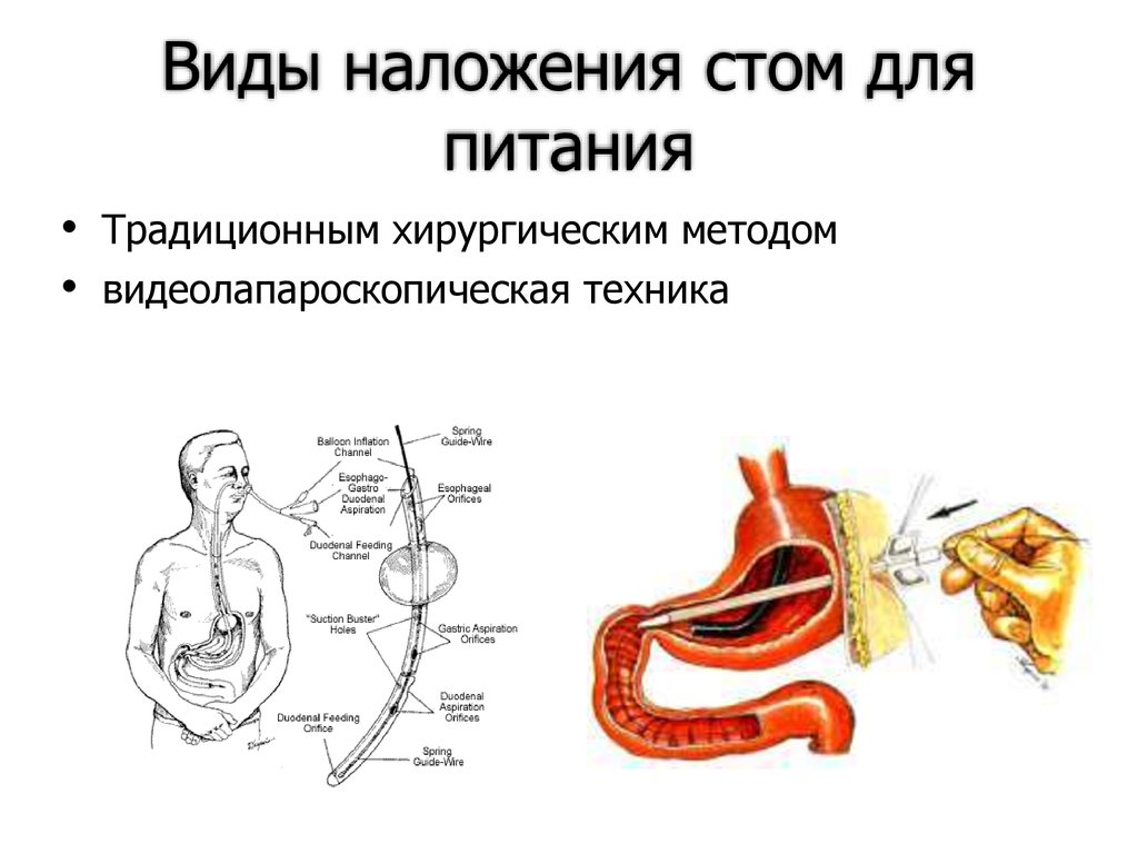 Виды стом презентация