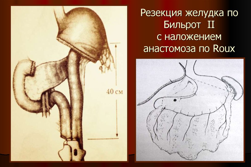 Анастомоз по ру схема