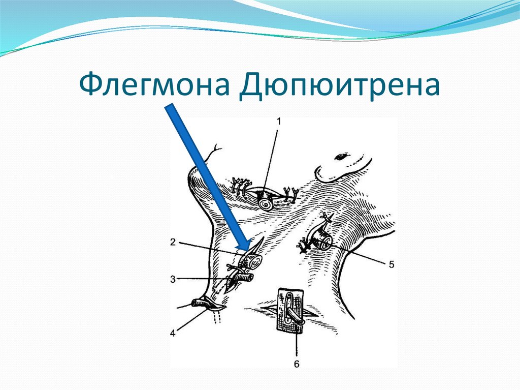 Флегмона стопы карта смп