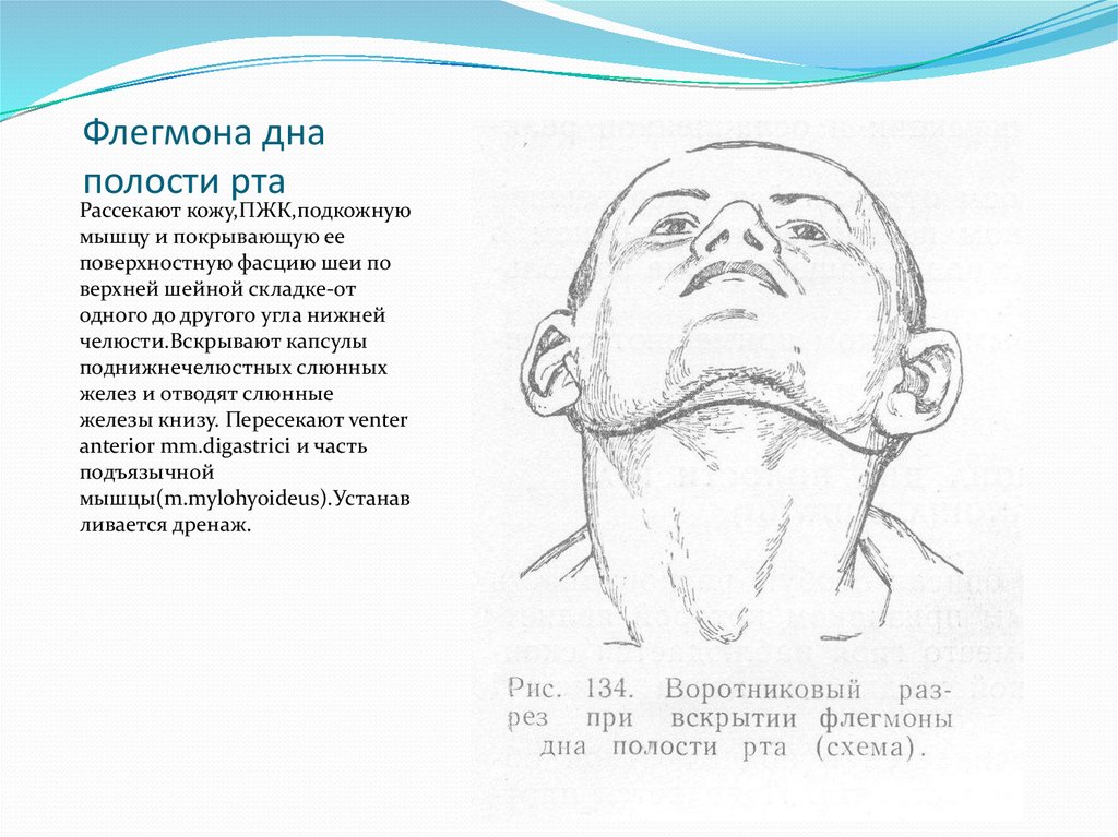 Флегмона подъязычной. Флегмона дна полости рта разрез. Разрез при флегмоне дна полости рта. Вскрытие флегмоны дна полости рта. Методики вскрытия флегмон дна полости рта.