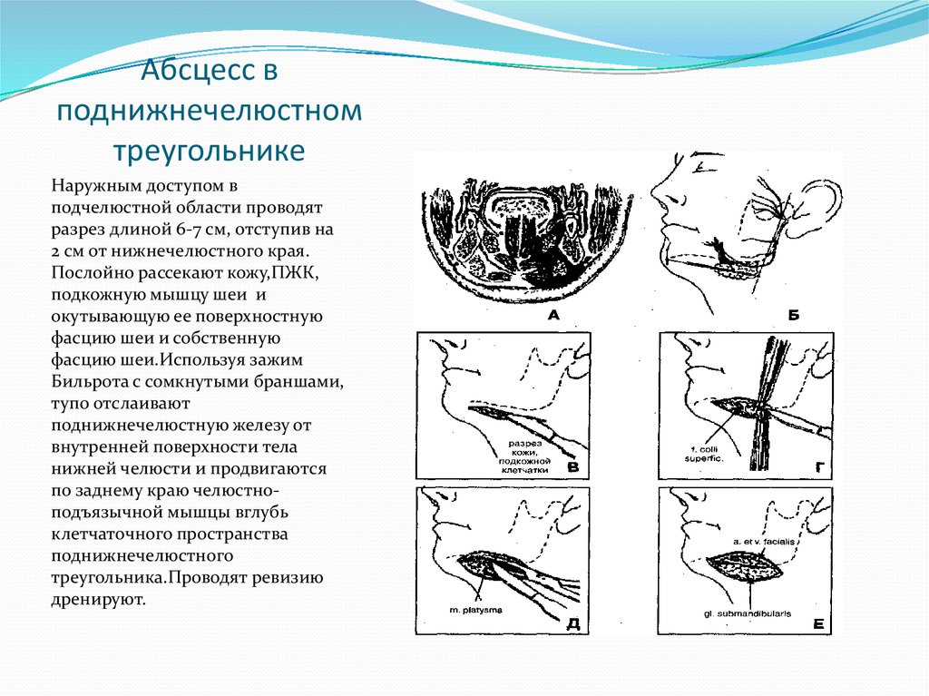 Абсцесс и флегмона поднижнечелюстной области презентация