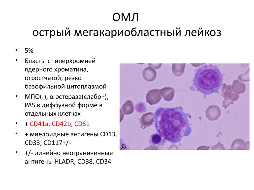 Лейкоз характеризуется. Бластные клетки в крови при лейкозе. Острый миелобластный лейкоз бласты. Острый мегакариоцитарный лейкоз. Острый мегакариобластный лейкоз характеризуется.