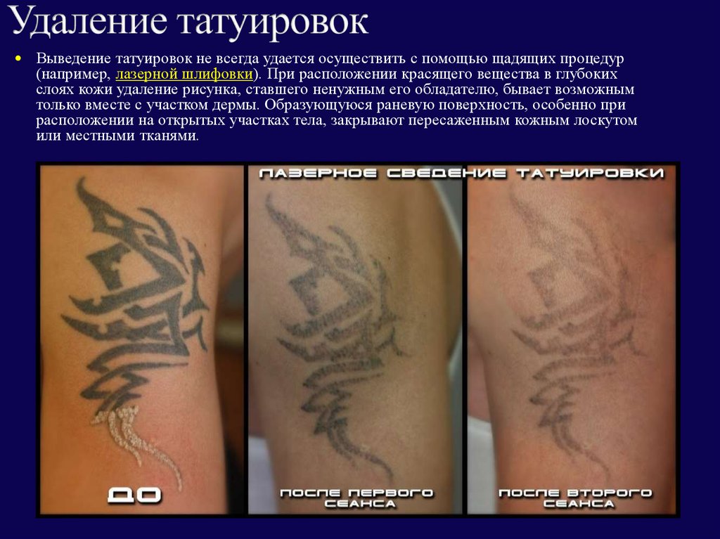 Химический способ выведения татуировок