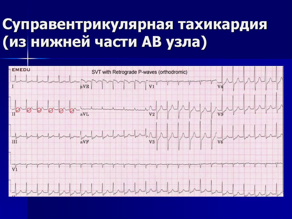 Экг картина при пароксизме суправентрикулярной тахикардии имеет вид